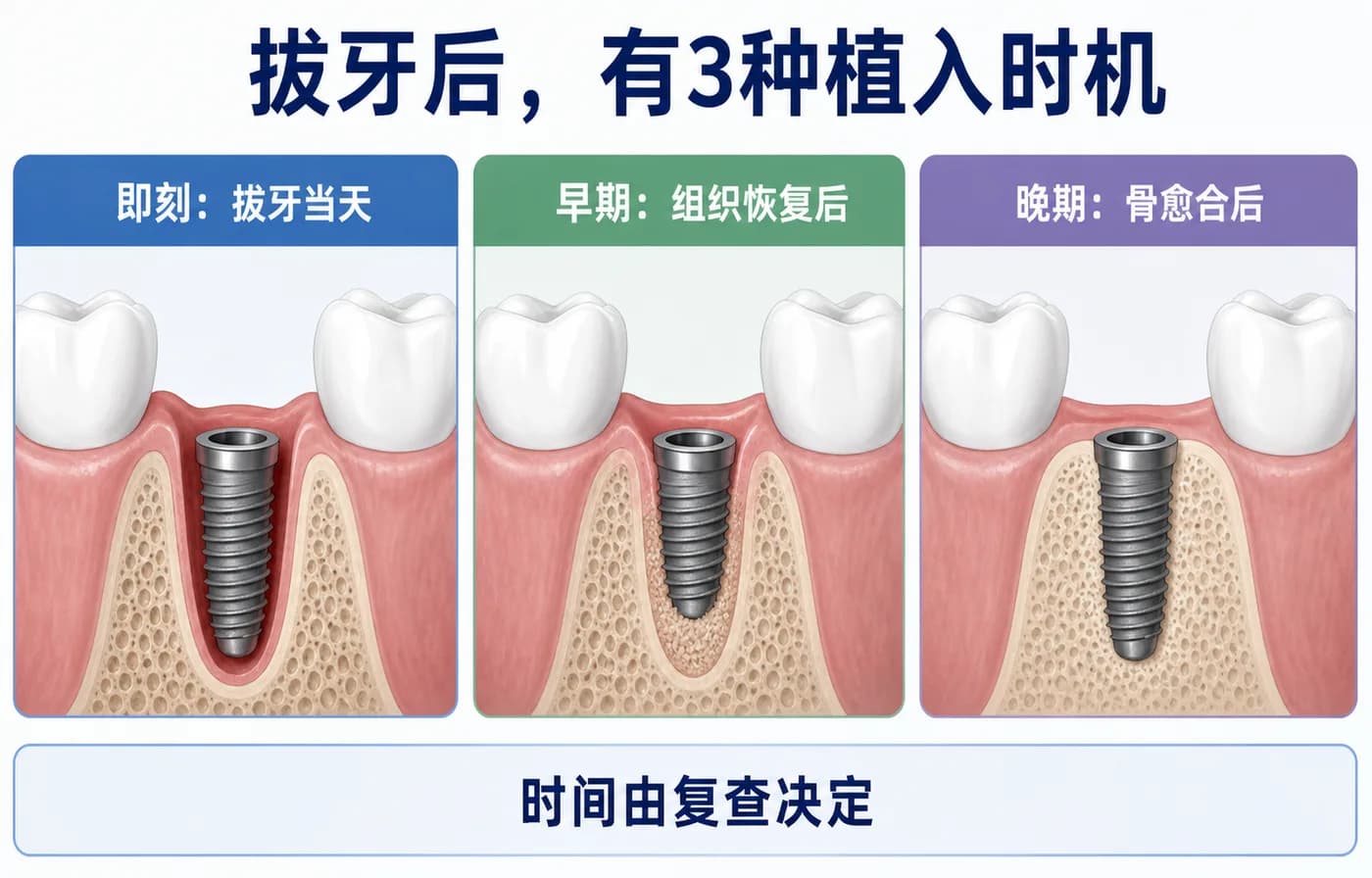 即刻、早期和晚期种植的时间轴