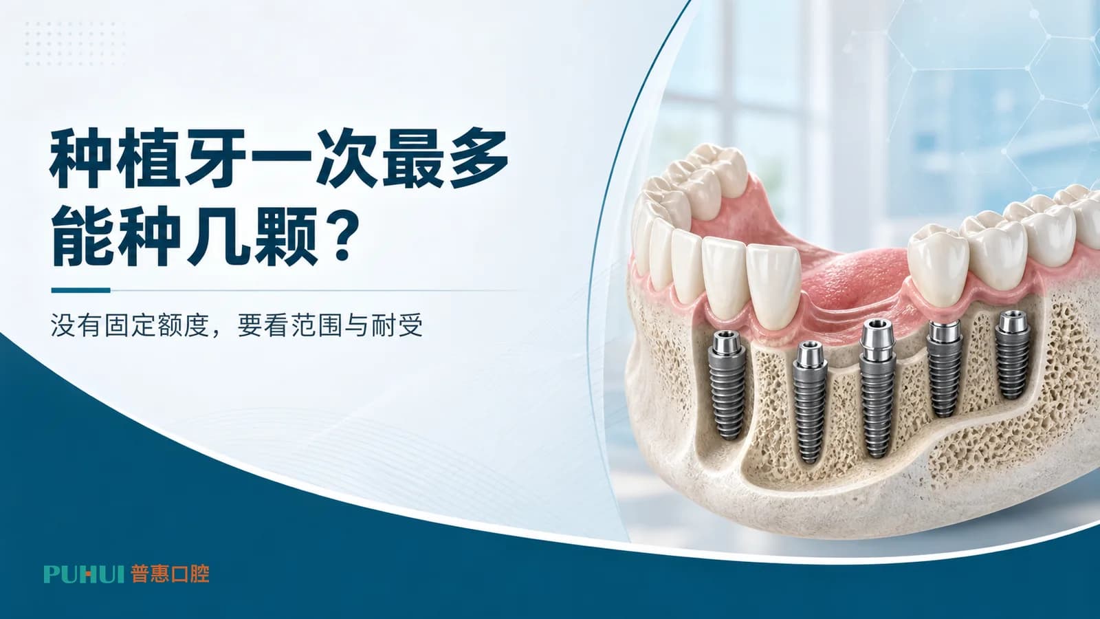 种植牙一次最多能种几颗?为什么有人一次完成,有人要分阶段?科普封面