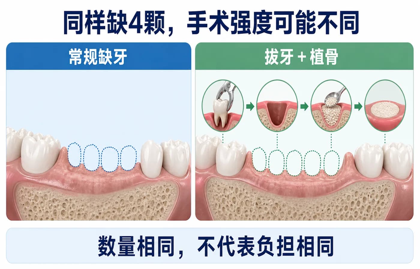 同样缺四颗,简单缺牙与拔牙植骨的手术负担不同