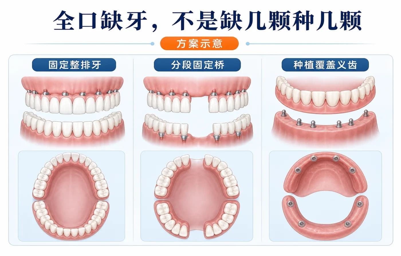 全口缺牙不是缺几颗种几颗,要从修复目标反推植体分布